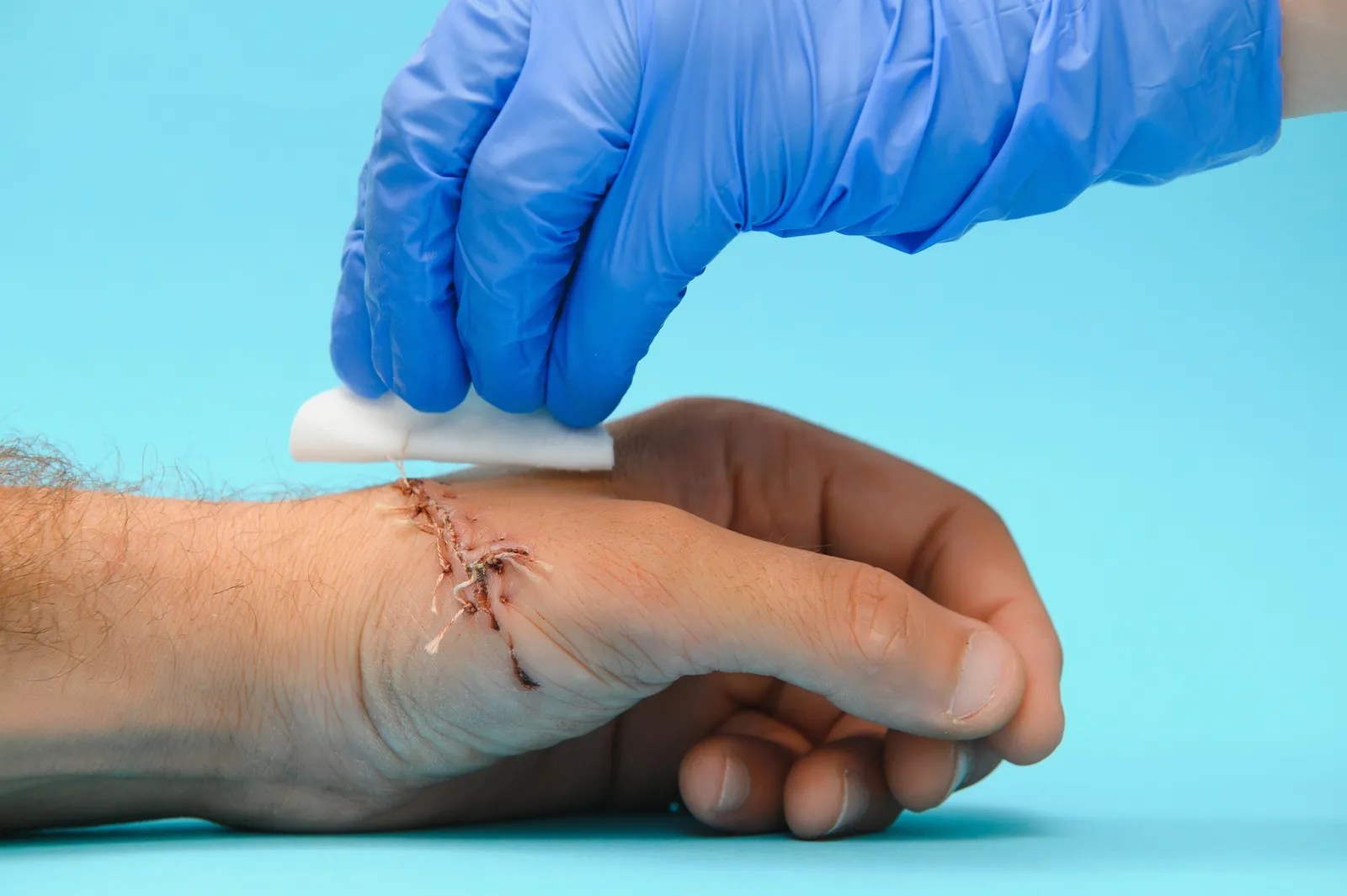 Wound Dressing & Suturing